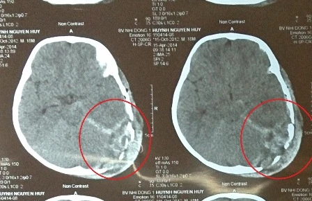 Hộp sọ của bé H. bị vỡ thành nhiều mảnh